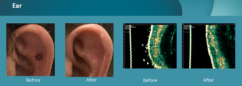 Before and after pictures of image-guided SRT treatment on a patient's ear