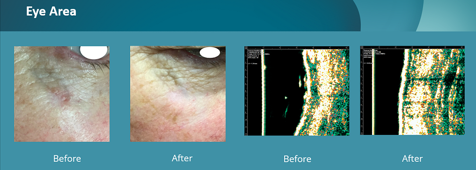 Before and after pictures of image-guided SRT treatment on a patient's eye area