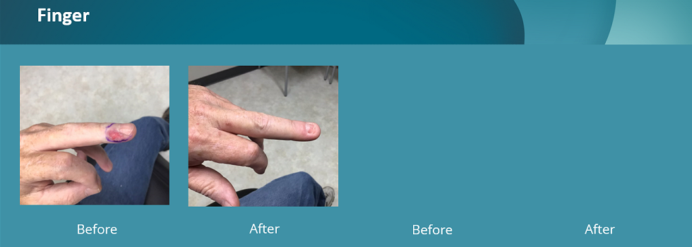 Before and after pictures of image-guided SRT treatment on a patient's finger